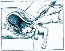 Partial-birth abortion technique